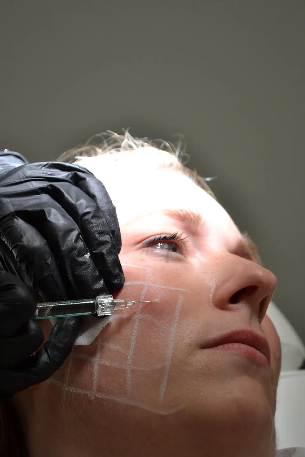 RF- Microneedling